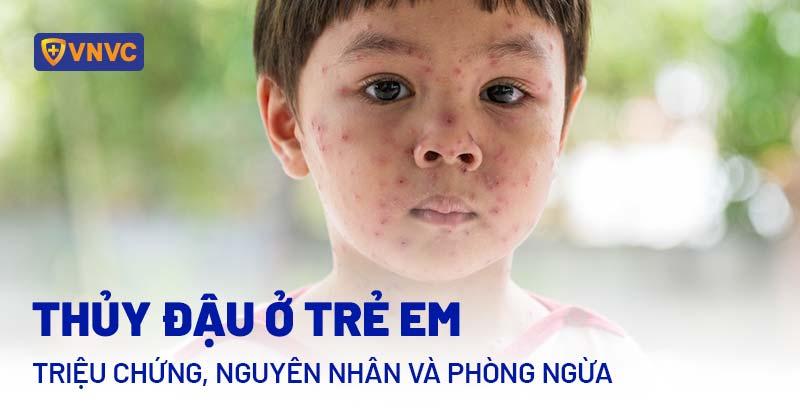 Cac dau hieu canh bao bien chung nguy hiem cua thuy dau o tre